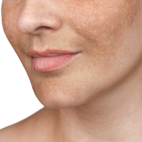 a women's face with some visible pigmentation and discolouration