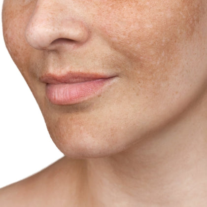 a women's face with some visible pigmentation and discolouration