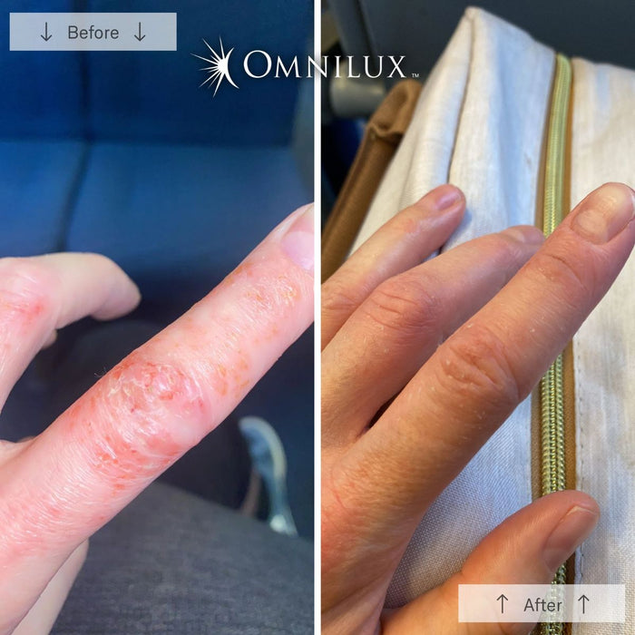 OMNILUX Contour LED Glove