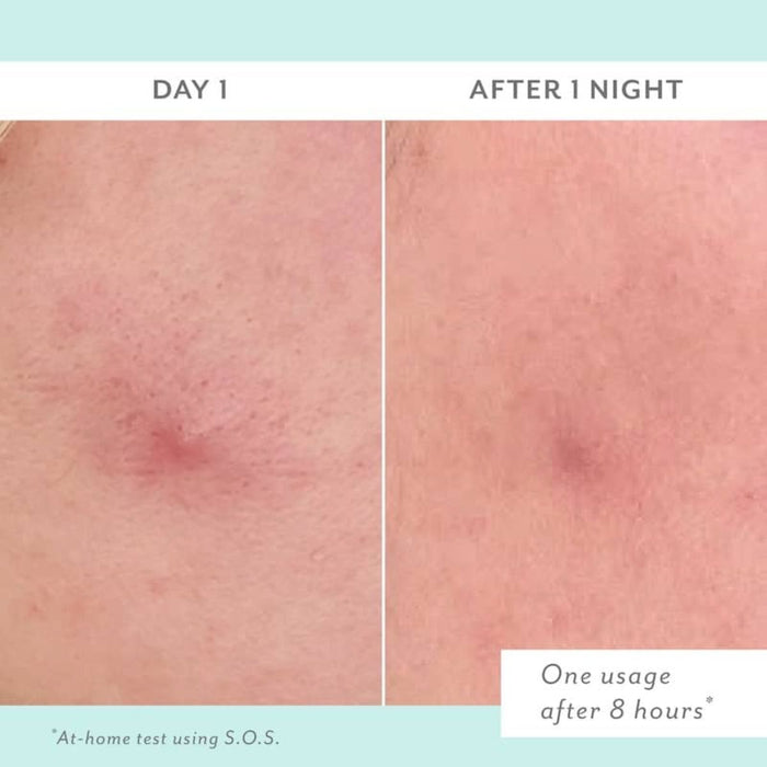 Patchology S.O.S. Totally-Invisible Clarifying Liquid Patch