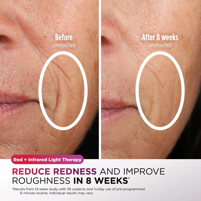 Pre-Order Shark CryoGlow Under-Eye Cooling & LED Anti-Ageing & Blemish Repair Mask Lilac Chill