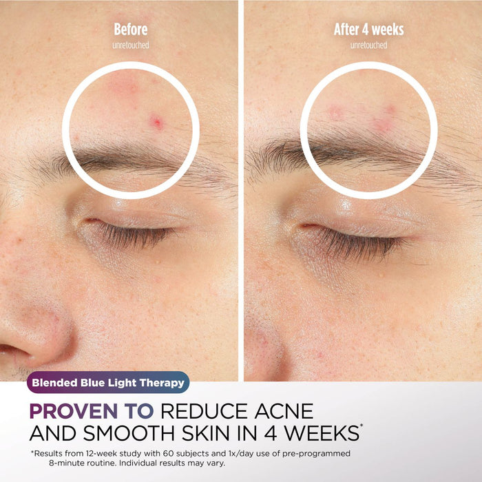 Pre-Order Shark CryoGlow Under-Eye Cooling & LED Anti-Ageing & Blemish Repair Mask Lilac Chill