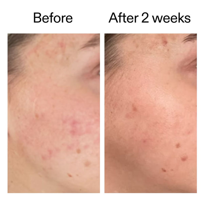 The Inkey List Dioic Acid Serum