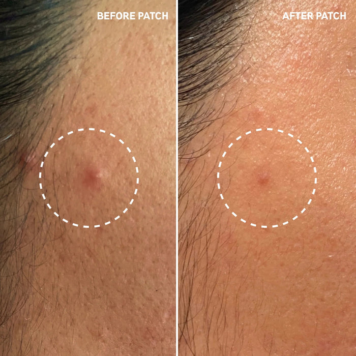 The Inkey List Hydrocolloid Pimple Patches