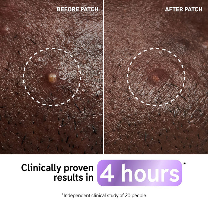 The Inkey List Spot On Set.