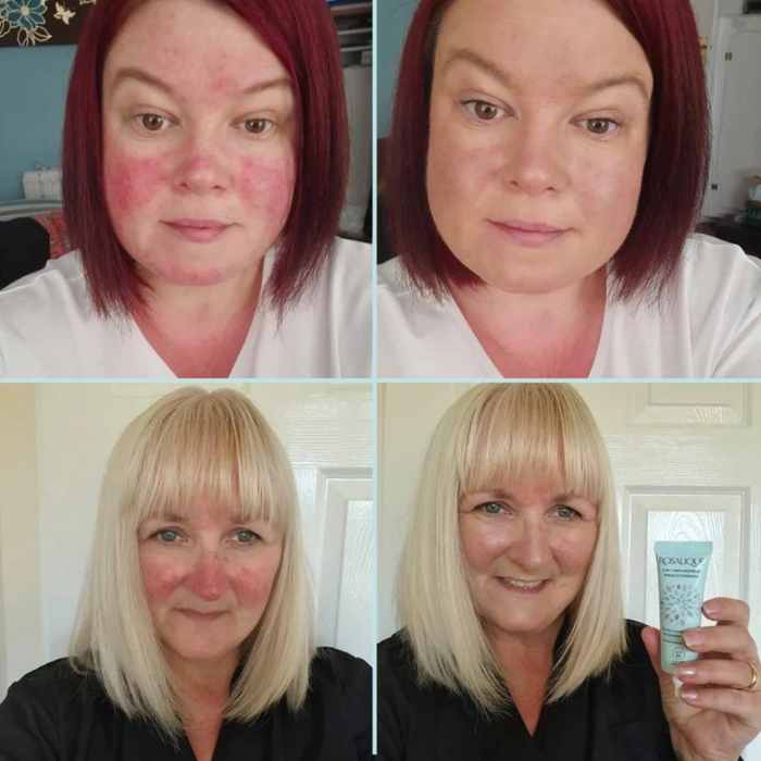 Rosalique 3 in 1 Anti Redness Miracle Formula before and after