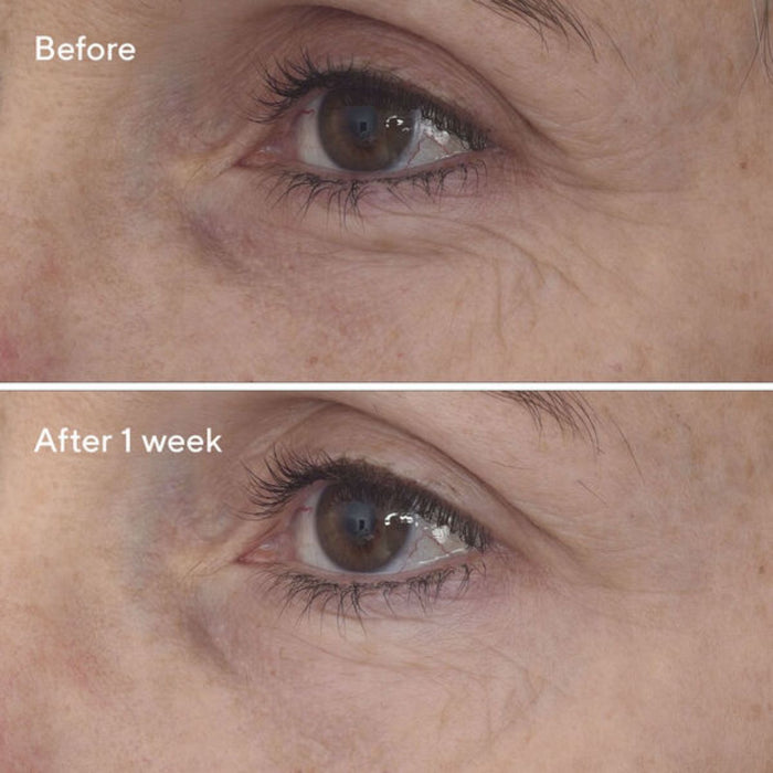 15/o - Finance urad Retinal ReSculpt Eye Lift Treatent - Resurgence 15/o - Finance urad Retinal ReSculpt Eye Lift Treatent - Resurgence