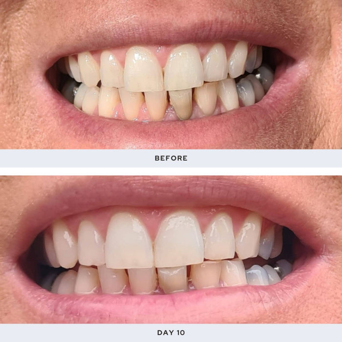 Spotlight Oral Care Professional LED Teeth Whitening System