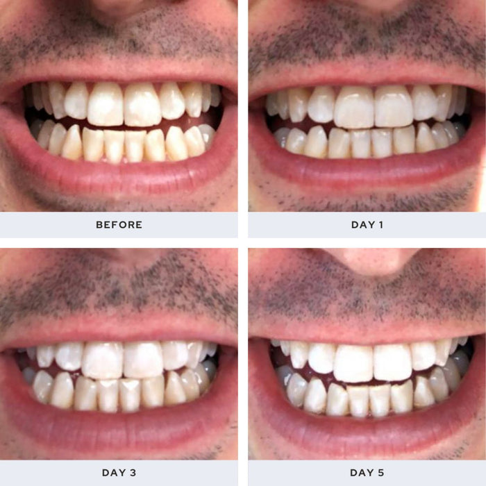 Spotlight Oral Care Professional LED Teeth Whitening System